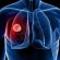 Últimos avanços da imunoterapia para câncer de pulmão